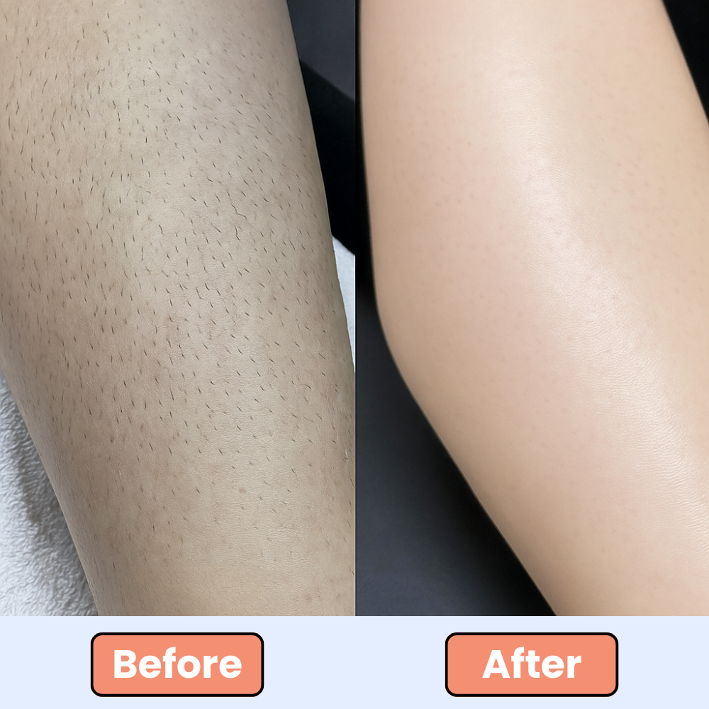 Ingrown Tonic Roller